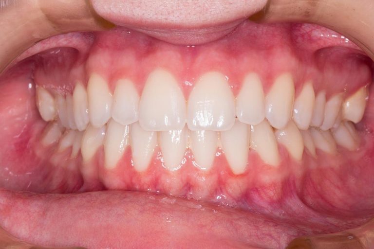 Implanty zębowe – jakie mają zalety?